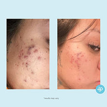 Load image into Gallery viewer, Salicylic 20% Gel Peel, Breakout and Pore Minimizer and Cleanser, Strength Level 2, 15-30 Full Facial Chemical Peels, 1 fl oz. e, 30 ml