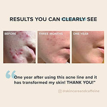 Load image into Gallery viewer, Paula's Choice CLEAR Regular Strength Acne Kit, 2% Salicylic Acid & 2.5% Benzoyl Peroxide for Facial Acne & Pores, Redness Relief, PACKAGING MAY VARY