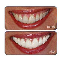 Load image into Gallery viewer, Go Smile Premium 2-In-1 Teeth Whitening System: Electric Tooth Brush+Teeth Whitening Gel For Healthier & Brighter Teeth | Instant Results, Safe On Dental Work, Crowns, Veneers, Bonding+More (Silver)