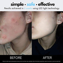 Load image into Gallery viewer, Darnlight LED Light Therapy Mask - 7 Color LED Face Mask Light Therapy Facial Treatment - Blue & Red Light Therapy Mask for Acne Fine Lines Wrinkles & Rosacea