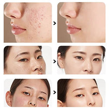 Load image into Gallery viewer, 15g Acne Removal Cream, Moisturizing Acne Scars Treatment Cream Skin Repairing Cream, Fades Acne Spot, stubborn Scars, Pigmentation & Blemish