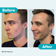 Load image into Gallery viewer, Proactiv 3 Step Acne Treatment - Benzoyl Peroxide Face Wash, Repairing Acne Spot Treatment For Face And Body, Exfoliating Toner - 30 Day Complete Acne Skin Care Kit