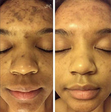 Load image into Gallery viewer, Admire My Skin Ultra-Potent Brightening Serum Dark Spot Corrector Remover 2% Hydroquinone Melasma Treatment Fade Cream with Kojic Acid Vitamin C, Salicylic Acid, Azelaic Acid, Lactic Acid Peel (1oz)