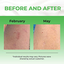 Load image into Gallery viewer, Scar Gel Reduce the Appearance of Old and New Scars - Acne, Burns, Cuts, Stretch Marks, C Section Marks & Plastic Surgery - Advanced Face and Body Formula, Men and Women Pureauty Naturals - 59ml