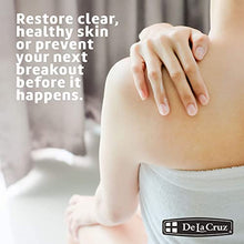 Load image into Gallery viewer, De La Cruz 10% Sulfur Ointment Acne Treatment - Medication to Clear Cystic Acne Pimples and Blackheads on Face and Body - Made in USA - 2.6 oz Tube