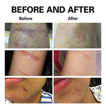 Load image into Gallery viewer, Lancs Acne Scar Removal Serum Skin Repair Essence for Reduces the Appearance of Old & New Scars, Wrinkles, Burns and Recovery Scar Treatment (5ml7 bottles)