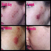 Load image into Gallery viewer, Admire My Skin Ultra-Potent Brightening Serum Dark Spot Corrector Remover 2% Hydroquinone Melasma Treatment Fade Cream with Kojic Acid Vitamin C, Salicylic Acid, Azelaic Acid, Lactic Acid Peel (1oz)