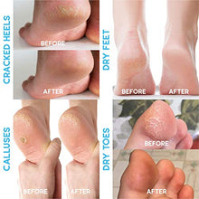 Load image into Gallery viewer, Tea Tree Oil Foot Balm, 100% All Natural Moisturizing Fast Acting Cream For Dry Feet & Cracked Heels, Extra Strength Callus Remover for Itchy Feet, Toenail Treatment, Calluses Remover & Callus Shaver