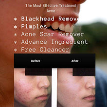 Load image into Gallery viewer, Acne spot Treatment Skin Serum Vitamin C, E and niacin amide Vitamin B3, B5, Acscanex for scars remove 50ML plus Face Cleanser 120Ml FREE