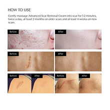 Load image into Gallery viewer, Scar Removal Cream - Advanced Treatment for Face & Body, Old & New Scars from Cuts, Stretch Marks, C-Sections & Surgeries - With Natural Herbal Extracts Formula
