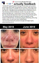 Load image into Gallery viewer, Acne Treatment Serum, BREYLEE Tea Tree Clear Skin Serum for Clearing Severe Acne, Breakout, Remover Pimple and Repair Skin (17ml,0.6oz)