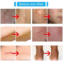 Load image into Gallery viewer, Silicone Scar Gel-Kinbeau Scar Remover Gel for Face, Body, C-Section Stretch Marks, Surgical, Burn, Acne, Old & New Scars,30g/1 OZ (white blue)