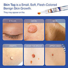 Load image into Gallery viewer, Reejoys Skin Tag & Mole Removal - Safe & Effective Formula for Skin Tag Remover (4 Packs)