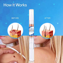 Load image into Gallery viewer, Reejoys Skin Tag & Mole Removal - Safe & Effective Formula for Skin Tag Remover (4 Packs)