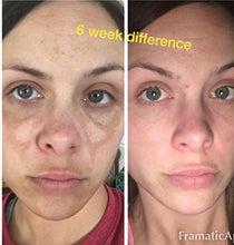 Load image into Gallery viewer, Admire My Skin Ultra-Potent Brightening Serum Dark Spot Corrector Remover 2% Hydroquinone Melasma Treatment Fade Cream with Kojic Acid Vitamin C, Salicylic Acid, Azelaic Acid, Lactic Acid Peel (1oz)