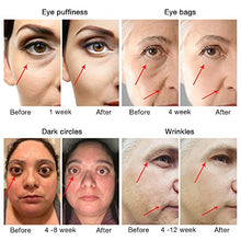 Load image into Gallery viewer, Dark Circles Under Eye Treatment for Women Men | Puffiness | Bags Under Eye | Dark Circle | Wrinkles | RF High Frequency Facial Under Eye Massager Machine, High Frequency Facial Under Eye Machine