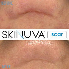 Load image into Gallery viewer, Skinuva Next Generation Scar Cream - Advanced Scar Removal Cream Formulated with Growth Factors (1 oz)