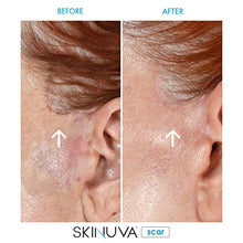 Load image into Gallery viewer, Skinuva Next Generation Scar Cream - Advanced Scar Removal Cream Formulated with Growth Factors (1 oz)
