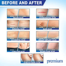 Load image into Gallery viewer, Premium Advanced Scar Gel Medical-Grade Silicone for Face, Body, Stretch Marks, C-Sections, Surgical, Burn, Acne | Old & New Scars, Clinically Proven | 30g