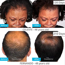 Load image into Gallery viewer, Theradome PRO LH80 - Medical Grade Laser Hair Growth Helmet - FDA Cleared for Men & Women. Promotes Hair Regrowth and Prevents Further Hair Loss with Premium Red Light Lasers