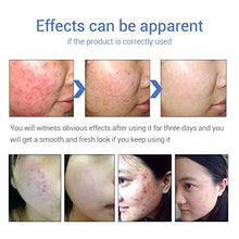 Load image into Gallery viewer, Face Herb Extract Acne Pimple Gel for Remove Acne Spots Comedone + Moisturizing Repairing Acne Mark (20 g)