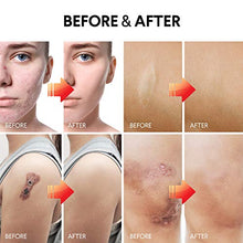 Load image into Gallery viewer, Scar Removal Cream, Scar Cream For Old Scars - Stretch Mark Removal Cream for Men & Women - Stretch Marks Relief and Burns Repair, Face Skin Repair Cream