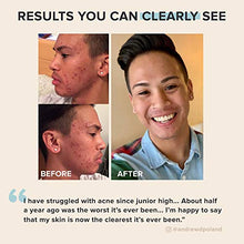 Load image into Gallery viewer, Paula's Choice CLEAR Extra Strength Acne Kit, 2% Salicylic Acid & 5% Benzoyl Peroxide for Severe Acne, Redness Relief, PACKAGING MAY VARY