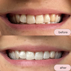 Smile Hero Purple Toner Teeth Whitener, Effortless at Home Teeth Whitener, Tooth Stain Remover, Purple Toothpaste, Safe & Zero Sensitivity Brightening