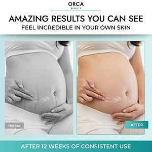 Belly Butter For Pregnancy Belly Cream - Stretch Mark Remover Body Butter For Women - Anti Stretch Mark Cream For Pregnancy - Firming Moisturizing Stretch Mark Cream Remover With Shea And Cocoa Butter