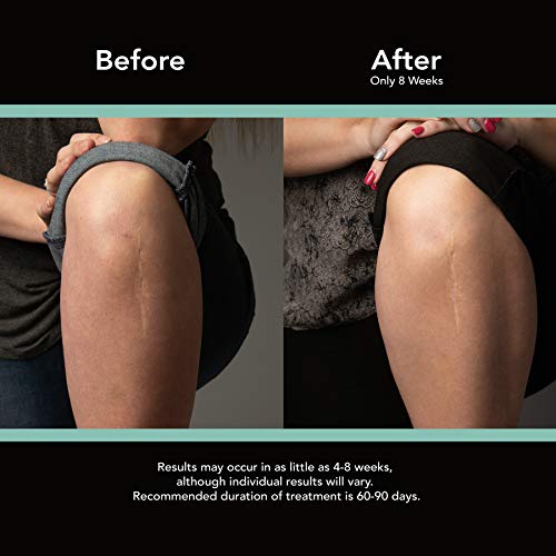 Load image into Gallery viewer, ScarAway Advanced Skincare Long Silicone Scar Sheets for Hypertrophic Scars and Keloids Caused by Surgery, Injury, Burns, C-Section and More, 1.5" x 7", 6 Sheets