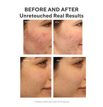 Load image into Gallery viewer, Murad Get Over Zit Kit - Breakout Skin Care Kit with Face Clarifying Cleanser, Breakout Skin Treatment and SPF Facial Mattifier - 3 Trial Size Skin Care Products for Blemish and Breakout Prone Skin
