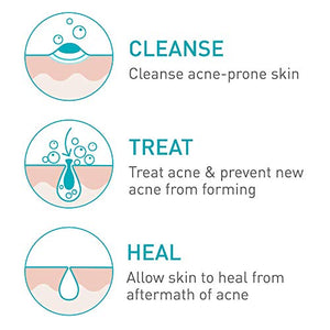 CeraVe Acne Foaming Cream Cleanser | Acne Treatment Face Wash with 4% Benzoyl Peroxide, Hyaluronic Acid, and Niacinamide | Cream to Foam Formula | 5 Oz