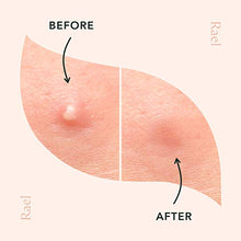 Load image into Gallery viewer, Rael Acne Pimple Healing Patch - Absorbing Cover, Invisible, Blemish Spot, Hydrocolloid, Skin Treatment, Facial Stickers, Two Sizes 10mm &amp; 12mm, Blends in with skin (96 Count)
