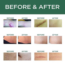 Load image into Gallery viewer, Scar Removal Cream Advanced Treatment for Old &amp; New Scars from Cuts Stretch Marks, C-Sections &amp; Surgeries With Natural Herbal Extracts Formula
