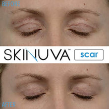 Load image into Gallery viewer, Skinuva Next Generation Scar Cream - Advanced Scar Removal Cream Formulated with Growth Factors (1 oz)
