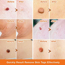 Load image into Gallery viewer, Skin Tag Remover, Skin Tag Removal Kit with 36 PCS Skin Tag Repair Patches, Efficient Skin Tag Remover Kit for Medium to Large Skin Tags
