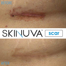 Load image into Gallery viewer, Skinuva Next Generation Scar Cream - Advanced Scar Removal Cream Formulated with Growth Factors (1 oz)
