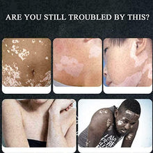 Load image into Gallery viewer, ZCXZ 6PCS White Tag Treatment Moisturizing Cream, Vitiligo Cream for White Spots On Skin, Improve Skin Pigmentation, Reduces Leukoplakia
