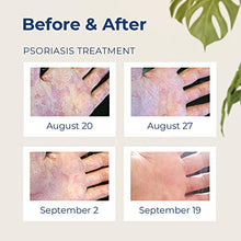 Load image into Gallery viewer, Gloves in a Bottle Shielding Lotion, Relief for Eczema and Psoriasis, (8 ounce)

