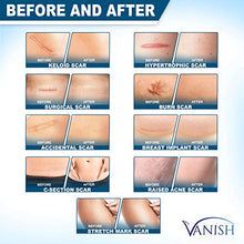 Load image into Gallery viewer, Vanish Silicone Scar Gel | Extra-strength Silicone Scar Removal Cream for Face, Body Stretch Marks, Keloid Scar, Acne Scar, C-Section and Surgical Scars | Old &amp; New Scars, for Men and Women | 1oz
