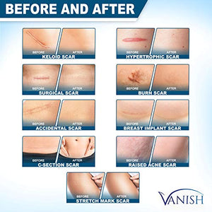Vanish Silicone Scar Gel | Extra-strength Silicone Scar Removal Cream for Face, Body Stretch Marks, Keloid Scar, Acne Scar, C-Section and Surgical Scars | Old & New Scars, for Men and Women | 1oz