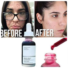 Load image into Gallery viewer, Fovely 30ml AHA 30% + BHA 2% Peeling Solution 10-Minute Exfoliating Face Brighten Serum Face Skin Care for Sensitive Skin
