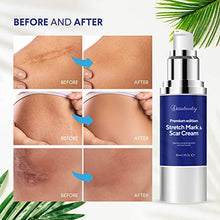 Load image into Gallery viewer, Beautivity Scar Cream, Advanced Scar Treatment, Premium Edition Stretch Mark &amp; Scar Cream, Acne, Surgery, Stretch Marks, Stretch Marks Relief and Burns Repair, Face Skin Repair Gel Made in Canada
