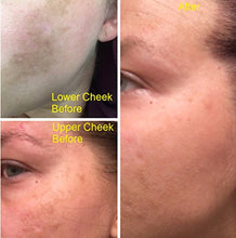 Load image into Gallery viewer, Admire My Skin Ultra-Potent Brightening Serum Dark Spot Corrector Remover 2% Hydroquinone Melasma Treatment Fade Cream with Kojic Acid Vitamin C, Salicylic Acid, Azelaic Acid, Lactic Acid Peel (1oz)
