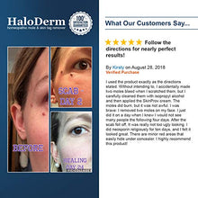 Load image into Gallery viewer, HaloDerm Advanced Skin Tag Remover &amp; Mole Remover - All Natural Skin Tag Cream - Remove up to 10 Skin Tags (FAST Results In As Little As 3-5 Applications) (1 Pack)
