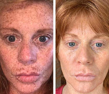Load image into Gallery viewer, Admire My Skin Ultra-Potent Brightening Serum Dark Spot Corrector Remover 2% Hydroquinone Melasma Treatment Fade Cream with Kojic Acid Vitamin C, Salicylic Acid, Azelaic Acid, Lactic Acid Peel (1oz)
