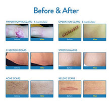 Load image into Gallery viewer, Aroamas, Silicone Scar Removal Sheets - for Keloid, C-Section, Hypertrophic, Surgical Scars and More Reusable and Washable 3&quot;×1.57&quot;, 4 Sheets (2 Month Supply)
